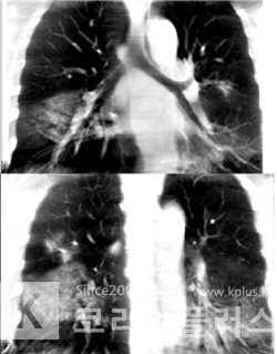 모바일 CT로 촬영한 코로나19 확진환자의 폐렴 소견